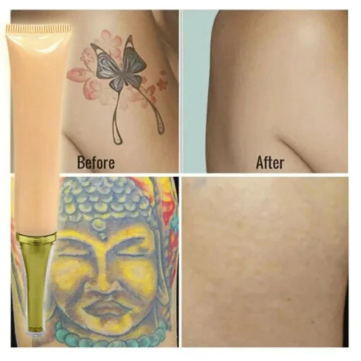 Permanent Tattoo Cream Removal