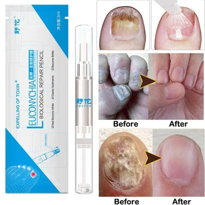 Fungus Treatment Repair Pencil