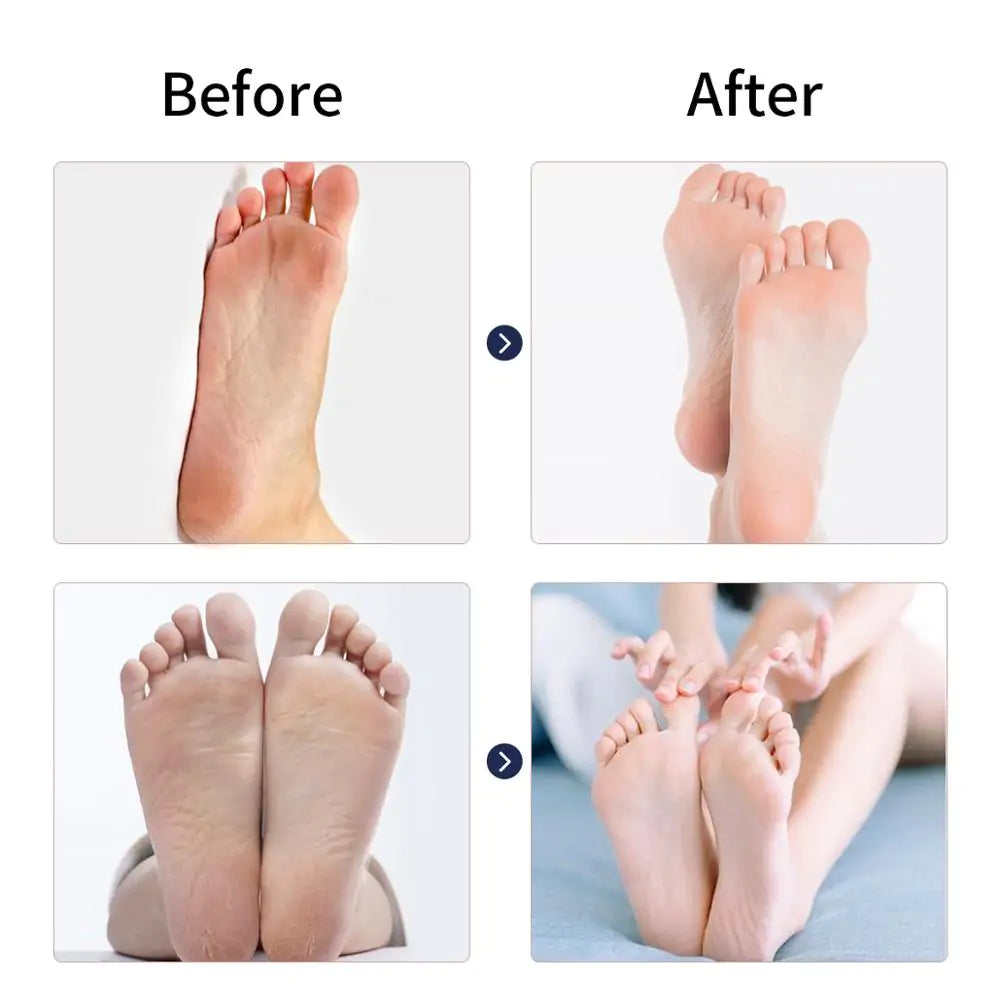 Electric Waterproof Feet Callus Remover