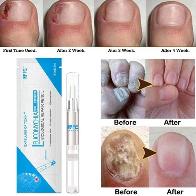 Fungus Treatment Repair Pencil